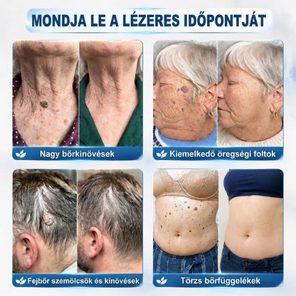 🚩𝑻𝒓𝒊𝒍𝒖𝒎𝒊𝒂® 🐠🥏Prémium roller toll | Szőrtüskék, anyajegyek és foltok eltávolítására
