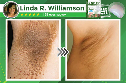 🌞Hudros® 2-az-1-ben Mikrotű & Hidrokoloid Tapasz 🇭🇺|👍Kiemelkedő Anyajegyek, Pattanások, Lapos Szemölcsök & Bőrkinövések Eltávolítója | Ráncok, Hegek & Bőrhibák Javítása | Láthatatlan Csillag Pattanástapasz Arcra & Testre | 144 db