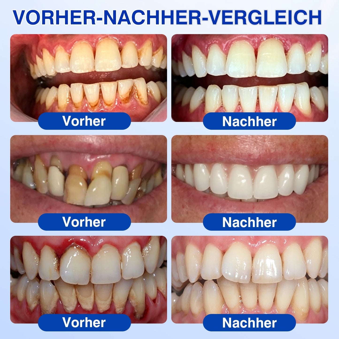 🩵🦷 Trilumia® 💗 GumRevive – fejlett gél az íny és a fogágy ápolására🇭🇺
