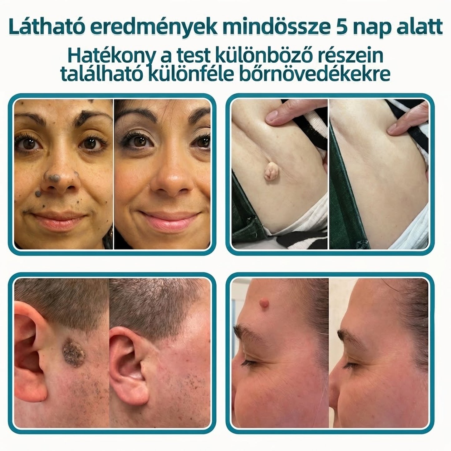 🎉🇭🇺 Healrize® 2 az 1-ben mikrotűs + hidrokolloid tapasz 💫 | Anyajegy, pattanás, lapos szemölcs és bőrkinövés ápolására | Ráncok, hegek és bőrhibák megjelenésének javítására | Láthatatlan tapasz arcra és testre