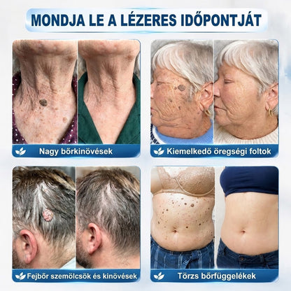 CureVivo® 7 napos bőrkinövés- és folteltávolító krém (fájdalommentes formula – hegek nélkül) 🌹