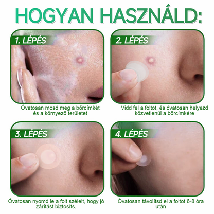 🌞Hudros® 2-az-1-ben Mikrotű & Hidrokoloid Tapasz 🇭🇺|👍Kiemelkedő Anyajegyek, Pattanások, Lapos Szemölcsök & Bőrkinövések Eltávolítója | Ráncok, Hegek & Bőrhibák Javítása | Láthatatlan Csillag Pattanástapasz Arcra & Testre | 144 db