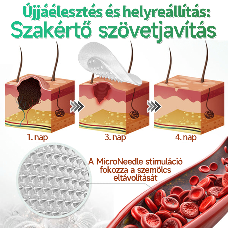 🌞Hudros® 2-az-1-ben Mikrotű & Hidrokoloid Tapasz 🇭🇺|👍Kiemelkedő Anyajegyek, Pattanások, Lapos Szemölcsök & Bőrkinövések Eltávolítója | Ráncok, Hegek & Bőrhibák Javítása | Láthatatlan Csillag Pattanástapasz Arcra & Testre | 144 db