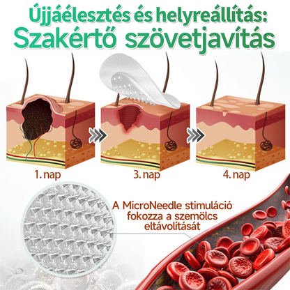 🌞Hudros® 2-az-1-ben Mikrotű & Hidrokoloid Tapasz 🇭🇺|👍Kiemelkedő Anyajegyek, Pattanások, Lapos Szemölcsök & Bőrkinövések Eltávolítója | Ráncok, Hegek & Bőrhibák Javítása | Láthatatlan Csillag Pattanástapasz Arcra & Testre | 144 db