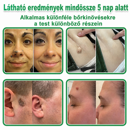 🌞Hudros® 2-az-1-ben Mikrotű & Hidrokoloid Tapasz 🇭🇺|👍Kiemelkedő Anyajegyek, Pattanások, Lapos Szemölcsök & Bőrkinövések Eltávolítója | Ráncok, Hegek & Bőrhibák Javítása | Láthatatlan Csillag Pattanástapasz Arcra & Testre | 144 db
