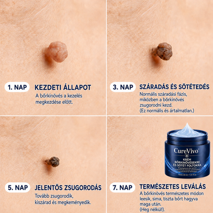 CureVivo® 7 napos bőrkinövés- és folteltávolító krém (fájdalommentes formula – hegek nélkül) 🌹