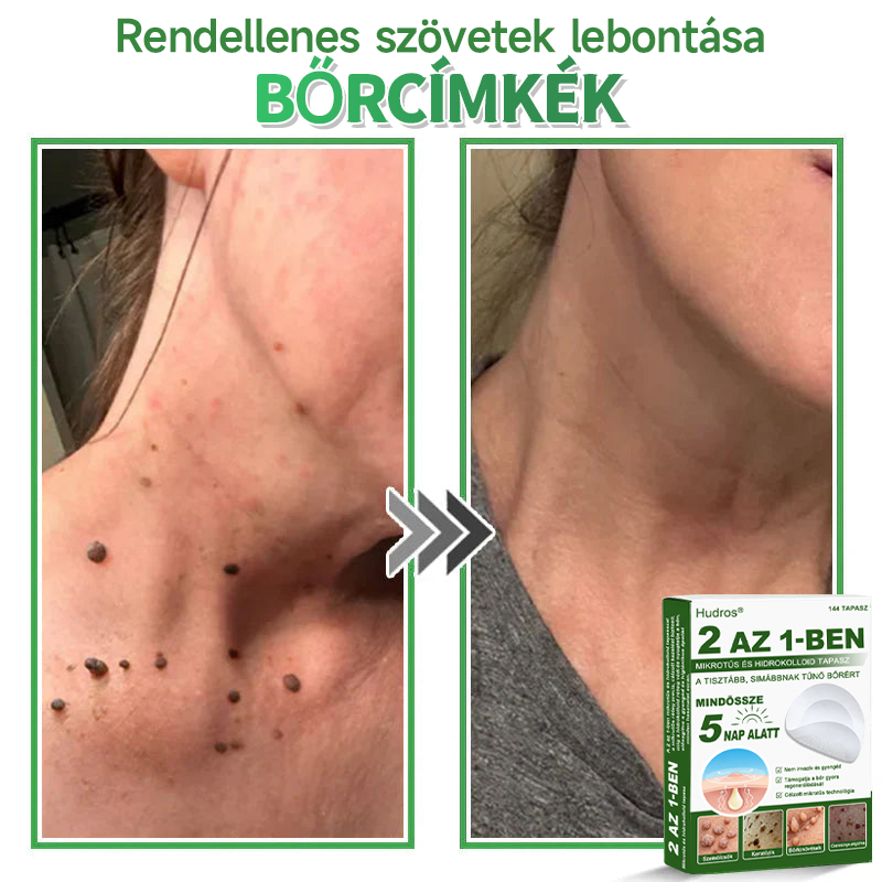 🌞Hudros® 2-az-1-ben Mikrotű & Hidrokoloid Tapasz 🇭🇺|👍Kiemelkedő Anyajegyek, Pattanások, Lapos Szemölcsök & Bőrkinövések Eltávolítója | Ráncok, Hegek & Bőrhibák Javítása | Láthatatlan Csillag Pattanástapasz Arcra & Testre | 144 db