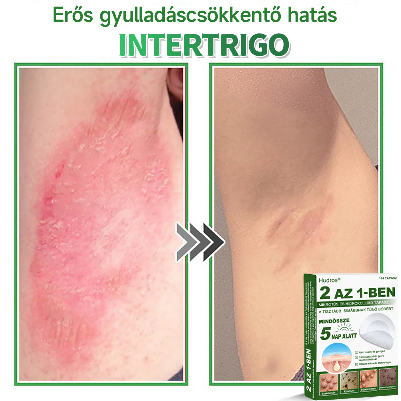 🌞Hudros® 2-az-1-ben Mikrotű & Hidrokoloid Tapasz 🇭🇺|👍Kiemelkedő Anyajegyek, Pattanások, Lapos Szemölcsök & Bőrkinövések Eltávolítója | Ráncok, Hegek & Bőrhibák Javítása | Láthatatlan Csillag Pattanástapasz Arcra & Testre | 144 db