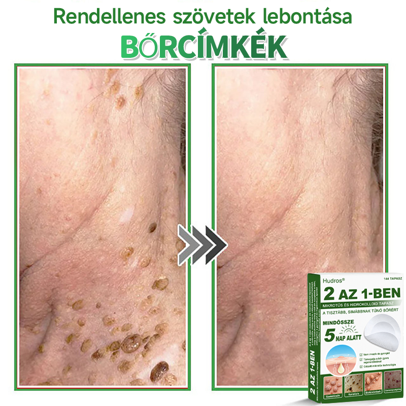 🌞Hudros® 2-az-1-ben Mikrotű & Hidrokoloid Tapasz 🇭🇺|👍Kiemelkedő Anyajegyek, Pattanások, Lapos Szemölcsök & Bőrkinövések Eltávolítója | Ráncok, Hegek & Bőrhibák Javítása | Láthatatlan Csillag Pattanástapasz Arcra & Testre | 144 db