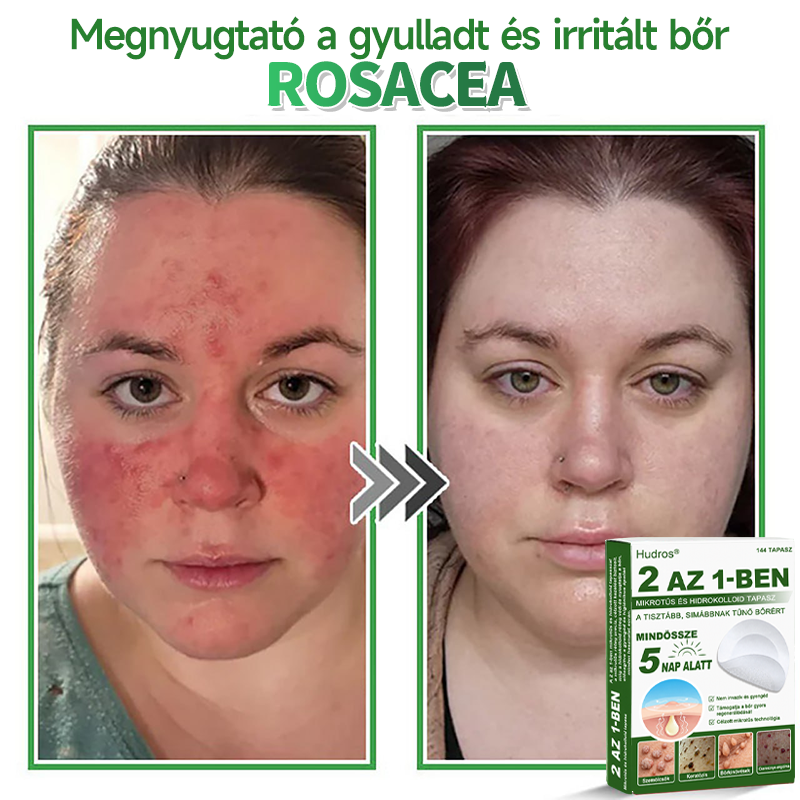 🌞Hudros® 2-az-1-ben Mikrotű & Hidrokoloid Tapasz 🇭🇺|👍Kiemelkedő Anyajegyek, Pattanások, Lapos Szemölcsök & Bőrkinövések Eltávolítója | Ráncok, Hegek & Bőrhibák Javítása | Láthatatlan Csillag Pattanástapasz Arcra & Testre | 144 db