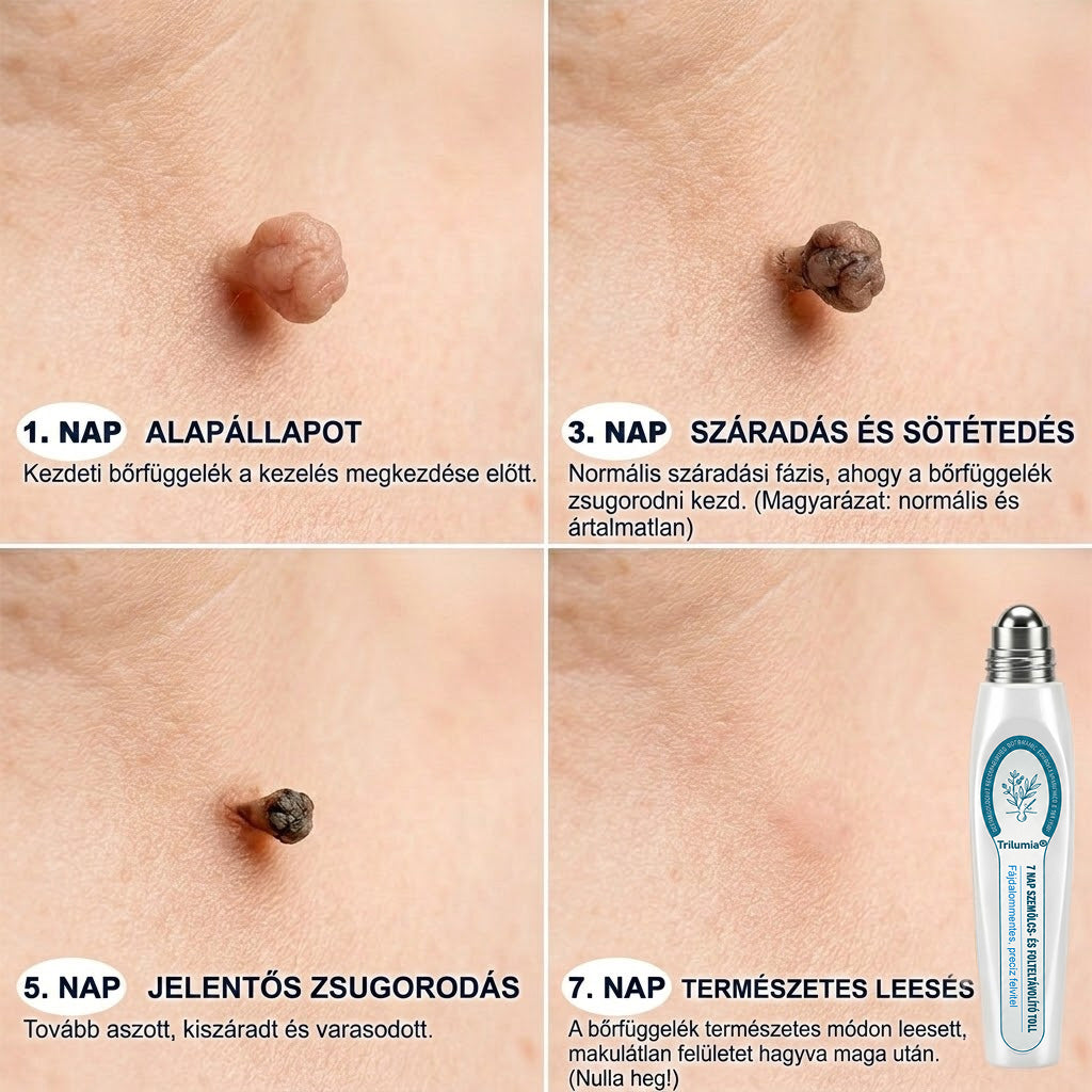 🚩𝑻𝒓𝒊𝒍𝒖𝒎𝒊𝒂® 🐠🥏Prémium roller toll | Szőrtüskék, anyajegyek és foltok eltávolítására