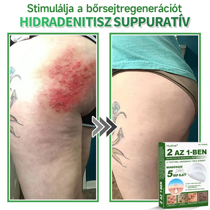 🌞Hudros® 2-az-1-ben Mikrotű & Hidrokoloid Tapasz 🇭🇺|👍Kiemelkedő Anyajegyek, Pattanások, Lapos Szemölcsök & Bőrkinövések Eltávolítója | Ráncok, Hegek & Bőrhibák Javítása | Láthatatlan Csillag Pattanástapasz Arcra & Testre | 144 db