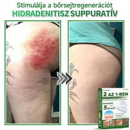 🌞Hudros® 2-az-1-ben Mikrotű & Hidrokoloid Tapasz 🇭🇺|👍Kiemelkedő Anyajegyek, Pattanások, Lapos Szemölcsök & Bőrkinövések Eltávolítója | Ráncok, Hegek & Bőrhibák Javítása | Láthatatlan Csillag Pattanástapasz Arcra & Testre | 144 db