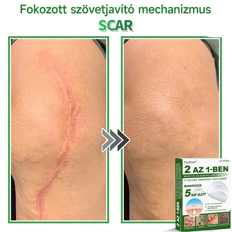 🌞Hudros® 2-az-1-ben Mikrotű & Hidrokoloid Tapasz 🇭🇺|👍Kiemelkedő Anyajegyek, Pattanások, Lapos Szemölcsök & Bőrkinövések Eltávolítója | Ráncok, Hegek & Bőrhibák Javítása | Láthatatlan Csillag Pattanástapasz Arcra & Testre | 144 db