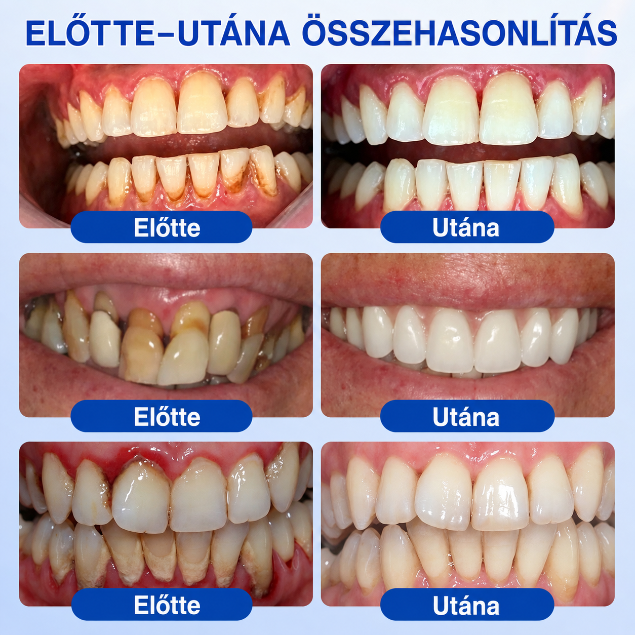 🚩 HEATWOLF® 🦷🥏GumRevive – Parodontális helyreállító gél👈