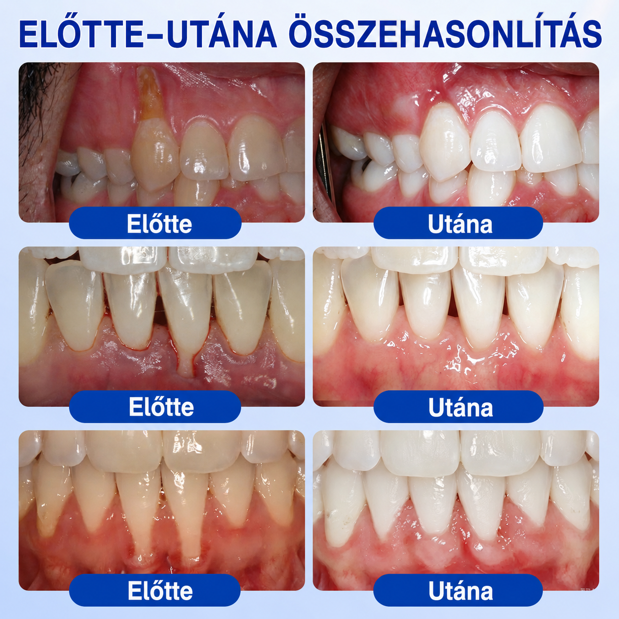 🚩 HEATWOLF® 🦷🥏GumRevive – Parodontális helyreállító gél👈