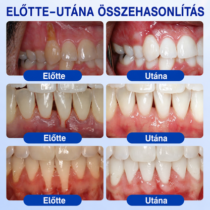 🚩 HEATWOLF® 🦷🥏GumRevive – Parodontális helyreállító gél👈