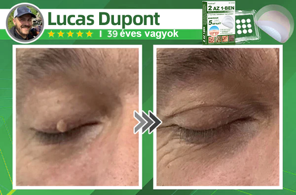 🌞Hudros® 2-az-1-ben Mikrotű & Hidrokoloid Tapasz 🇭🇺|👍Kiemelkedő Anyajegyek, Pattanások, Lapos Szemölcsök & Bőrkinövések Eltávolítója | Ráncok, Hegek & Bőrhibák Javítása | Láthatatlan Csillag Pattanástapasz Arcra & Testre | 144 db